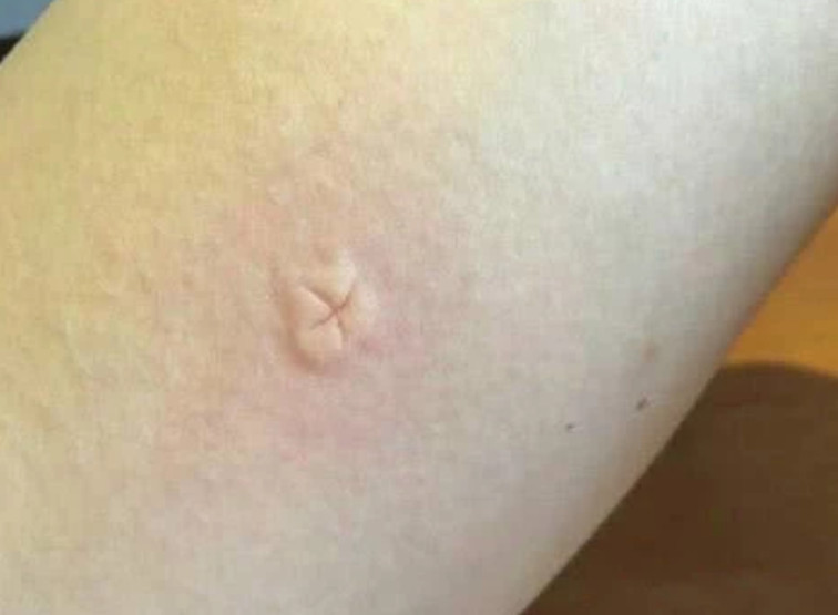 被蚊子咬了，"掐十字"能止痒？